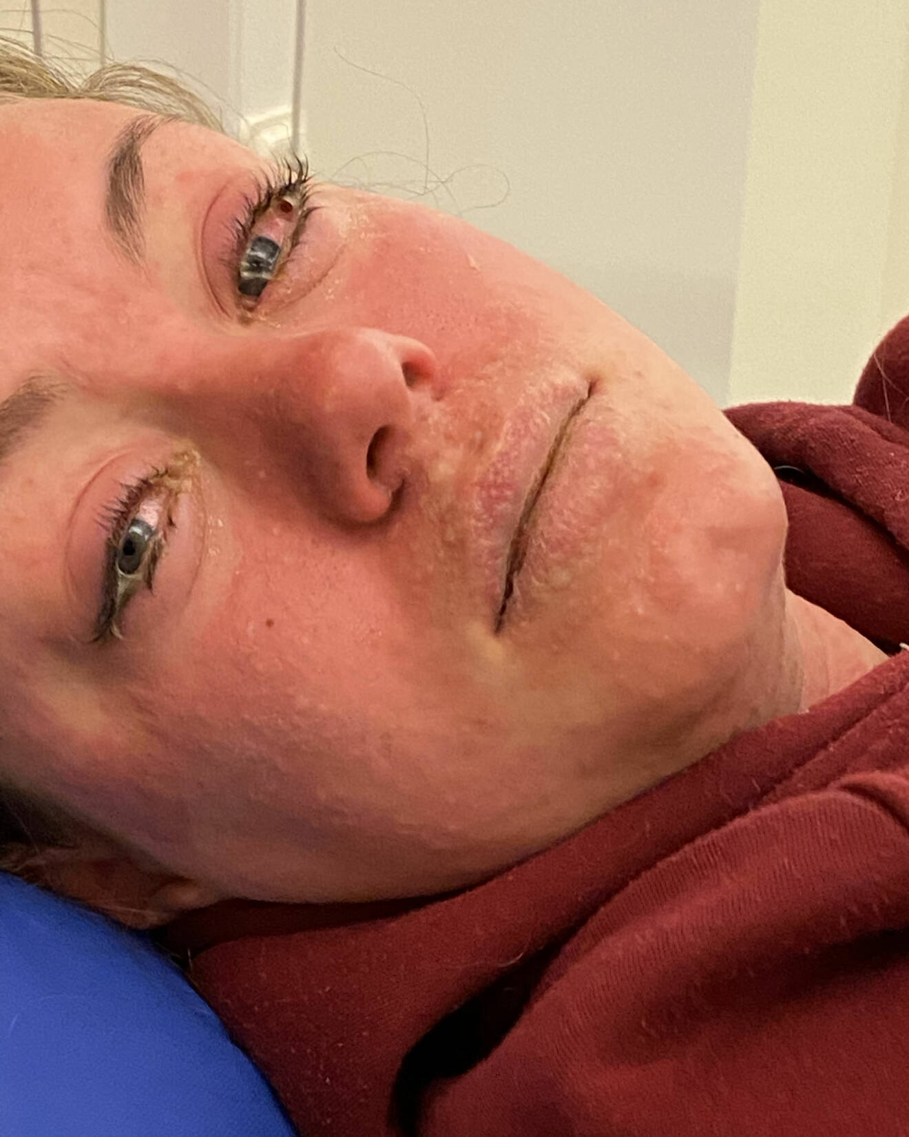 Alva Röines ansikte svullnade upp och hon fick blåsor över stora delar av ansiktet.