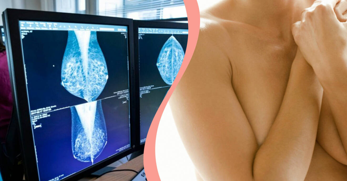 Till vänster, mammografi-bild, till höger, en kvinna som håller för sina bröst.