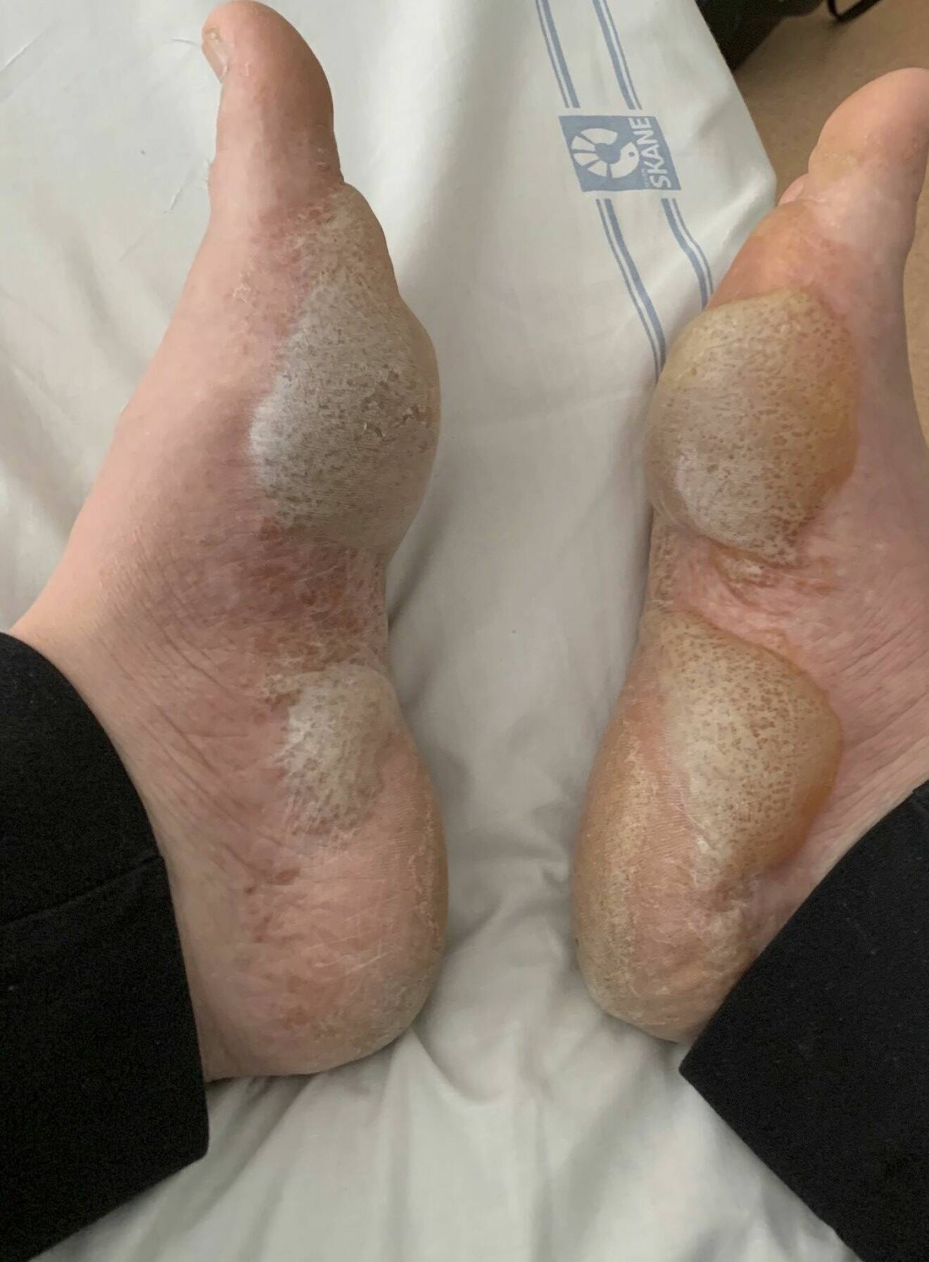 På grund av sjukdomen graviditetspemfigoid fick Gabriella Strand blåsor på fötterna stora som tennisbollar innan de sprack.