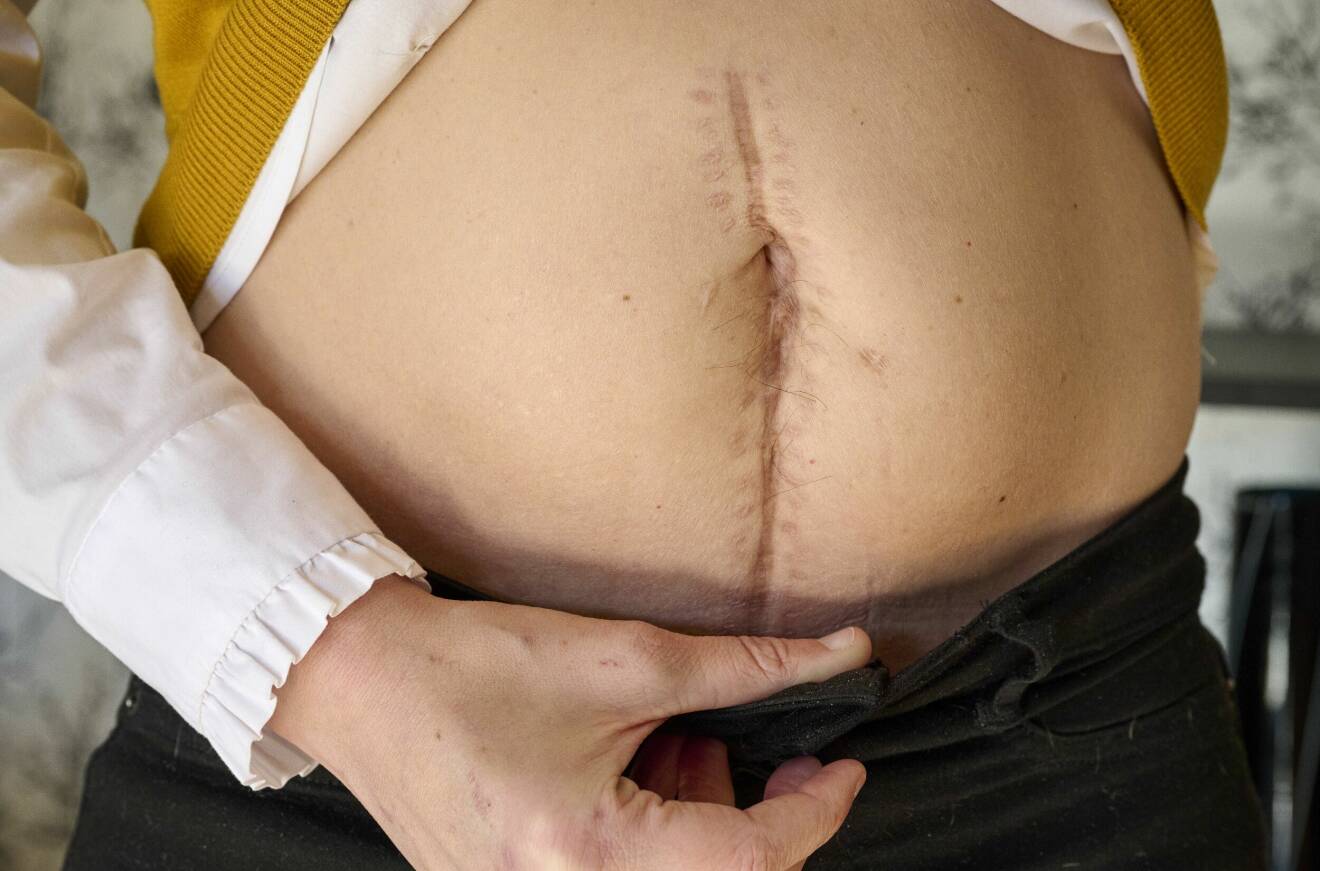 Jessica Lindgren visar upp ärret från operationen då en ny njure och bukspottkörtel transplanterades.