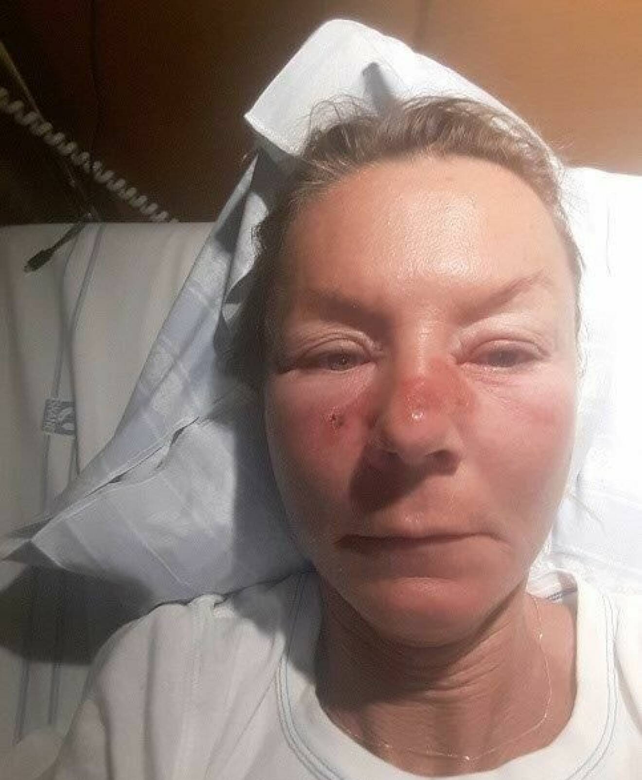 Pia Jensen ligger i en sjukhussäng med rosfeber.