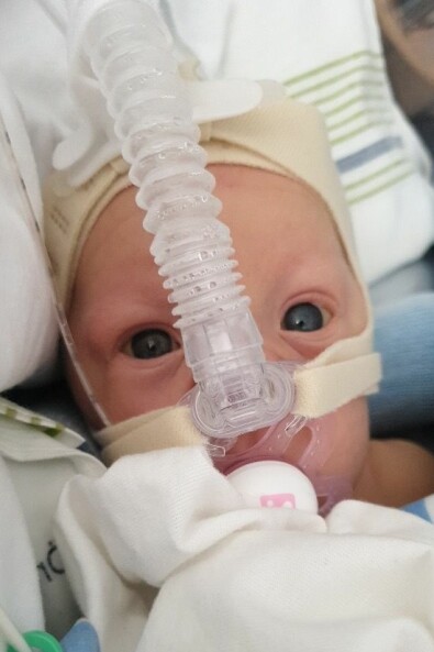 Den pigga blicken vittnar om att Luna har kämpaglöd! Foto: Privat En liten bebis med vaken blick som har en syrgasmask på sig.