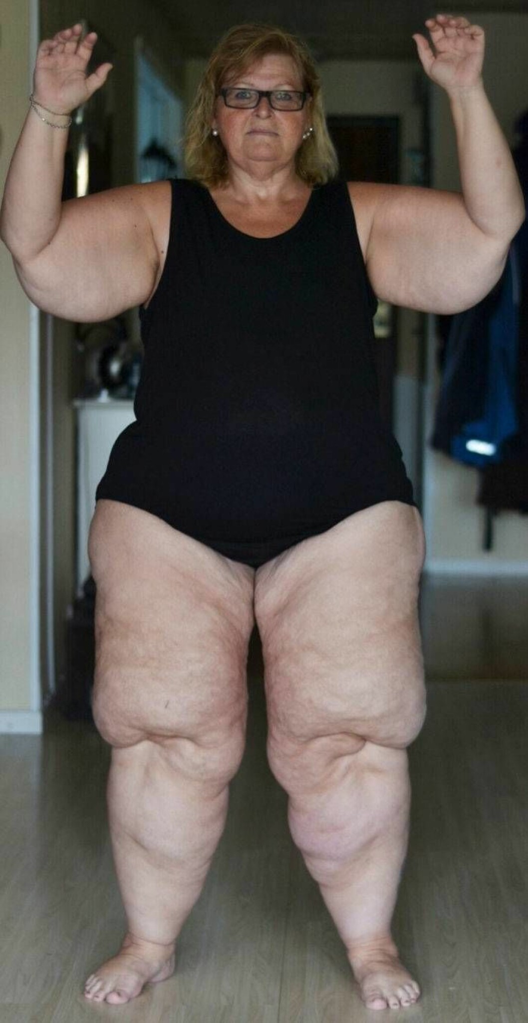 Irene har gått igenom tre stora ingrepp och sugit bort 18 kilo fett. – Det blir nog en operation till men sedan får det räcka, säger hon. Irene före operationen