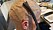 Jenny Kroon får behandling för sin hjärntumör med en så kallad Optune som har keramiska plattor som fästs på huvudet.