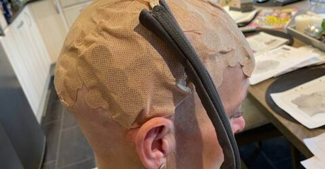 Jenny Kroon får behandling för sin hjärntumör med en så kallad Optune som har keramiska plattor som fästs på huvudet.