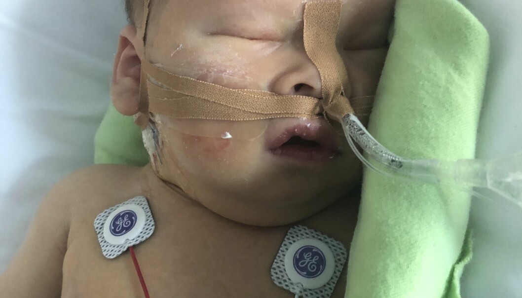 Fyra dagar efter operationen kunde Tim lämna respiratorn men fick stanna kvar på barnintensiven. Foto: privat Lille babyn med slangar och sladdar i sjuksäng med grön filt.