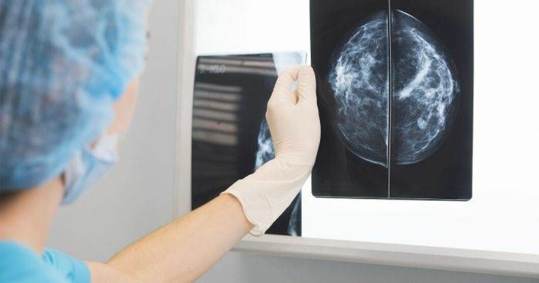 Med hjälp av mammografi kan läkarna upptäcka bröstcancer i ett tidigt skede. Foto: Shutterstock/TT Röntgenbild på bröst efter en mammografiundersökning