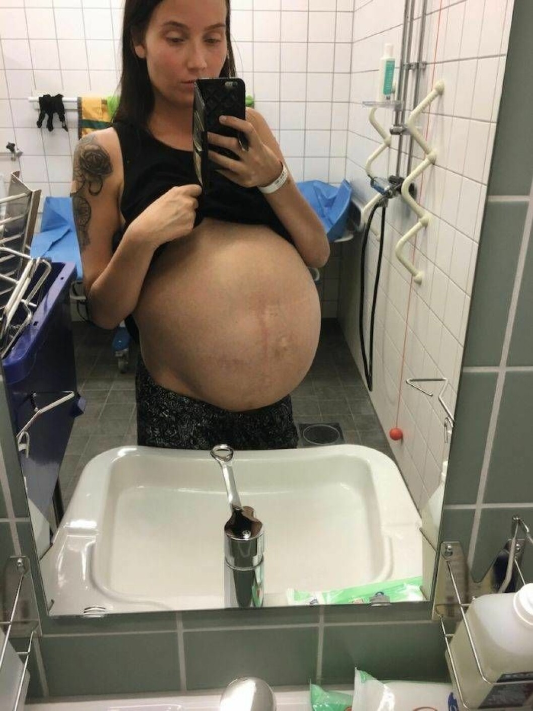 Före operationen var magen så uppsvälld att Olivia såg ut att vara höggravid. Bild på Olivias uppsvällda mage före transplantationen.