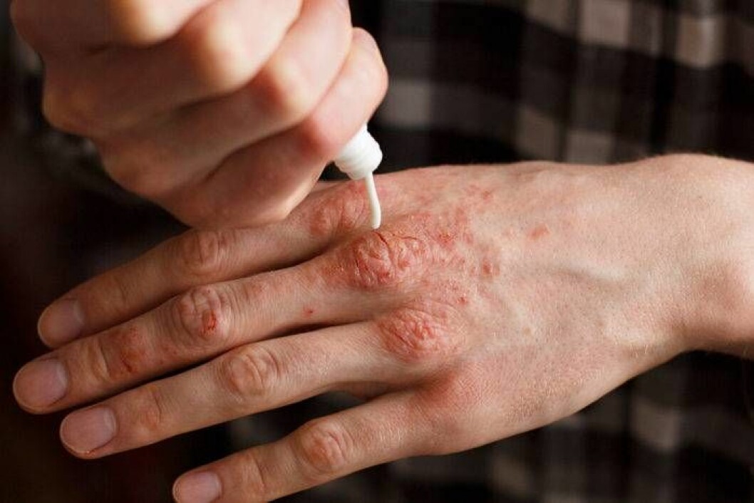 Psoriasis behandlas med kräm