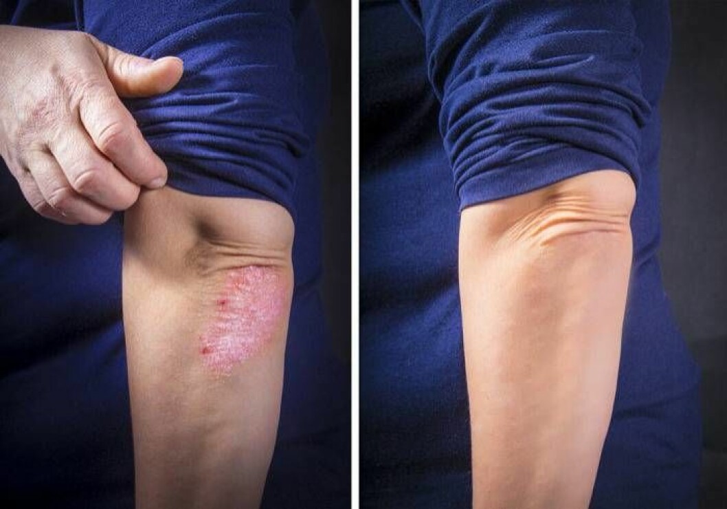 Psoriasis före och efter