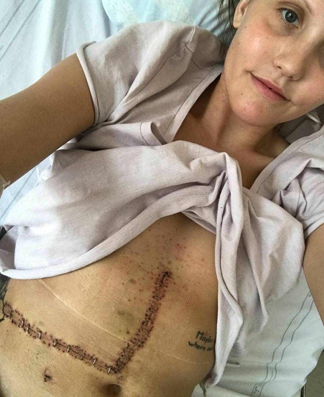 En privatbild från sjukhuset i Göteborg, efter transplantationen.