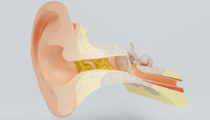 En illustrerad bild på hur örat ser ut inuti i genomskärning och när det bildats mycket vax i hörselgången.