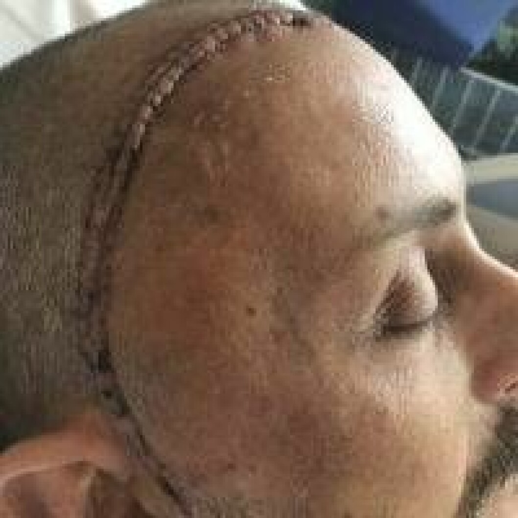 Stefano Catenaccis ärr efter operationen.