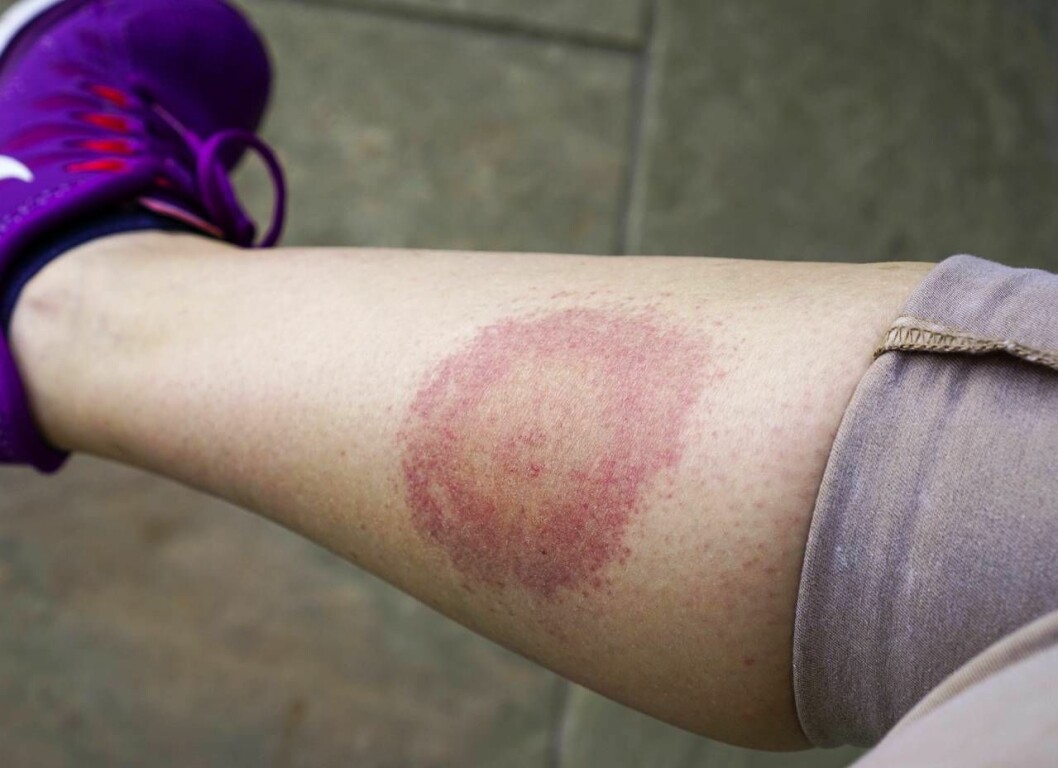 Tecken på borrelia. Foto: Shutterstock/TT Ben smittat med borrelia