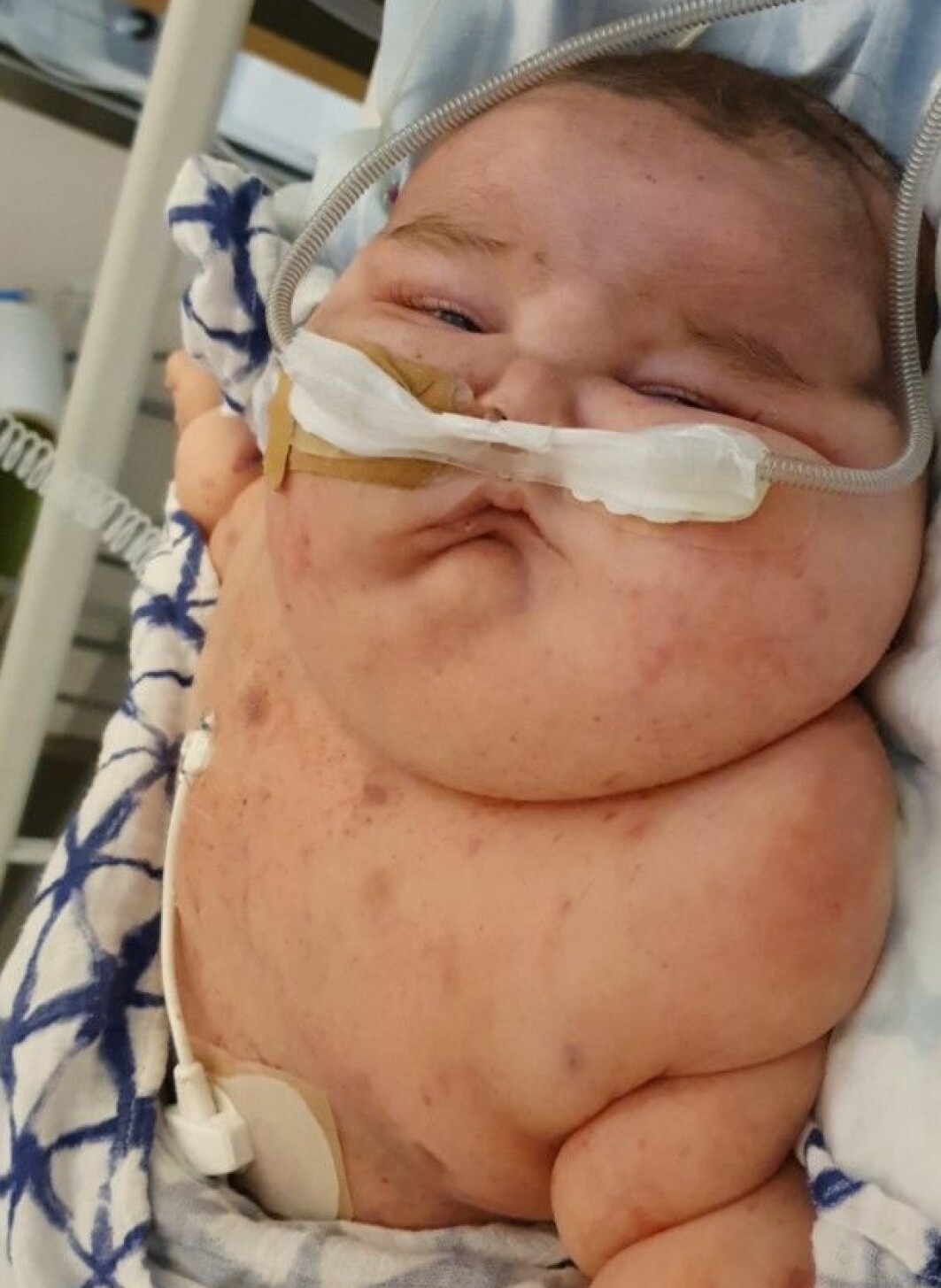 Walder fick mycket kortison under sin behandling, vilket gjorde att han svullnade upp i hela kroppen. Walder Johansson på sjukhuset, svullen i hela kroppen på grund av kortison.